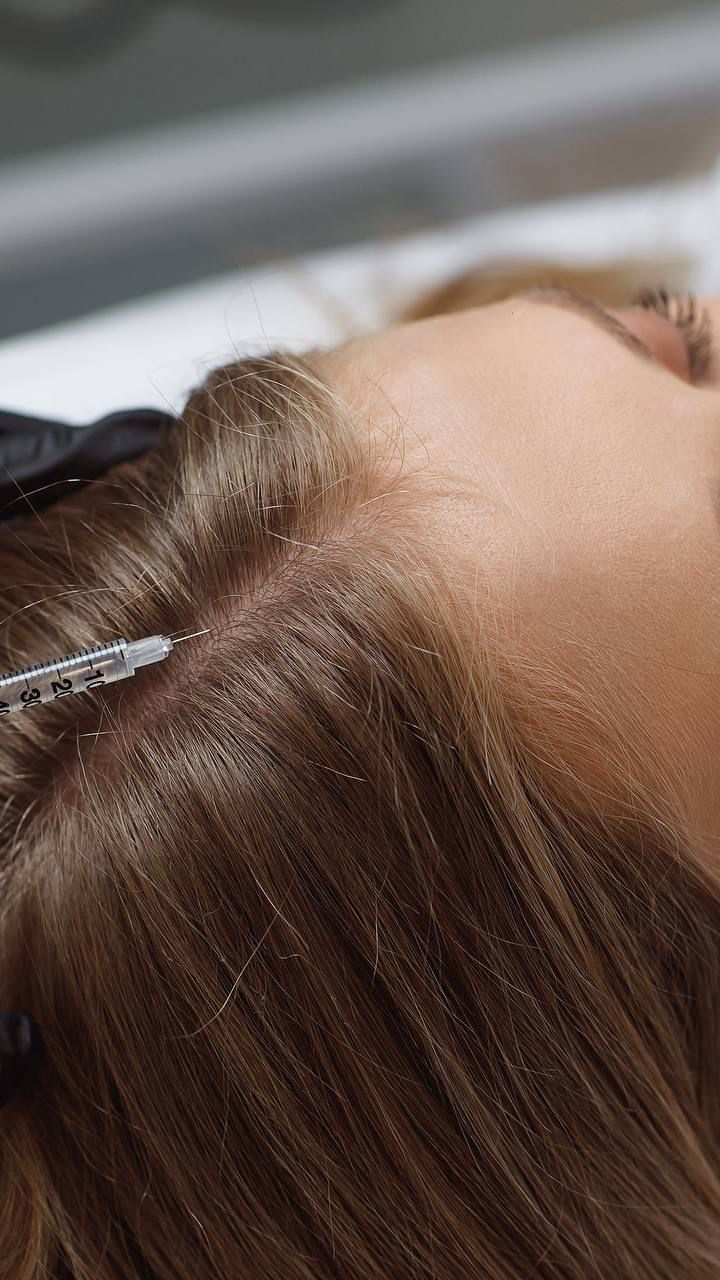 თმის მეზოთერაპია – ეფექტური გზა ძლიერი და ჯანსაღი თმისთვის