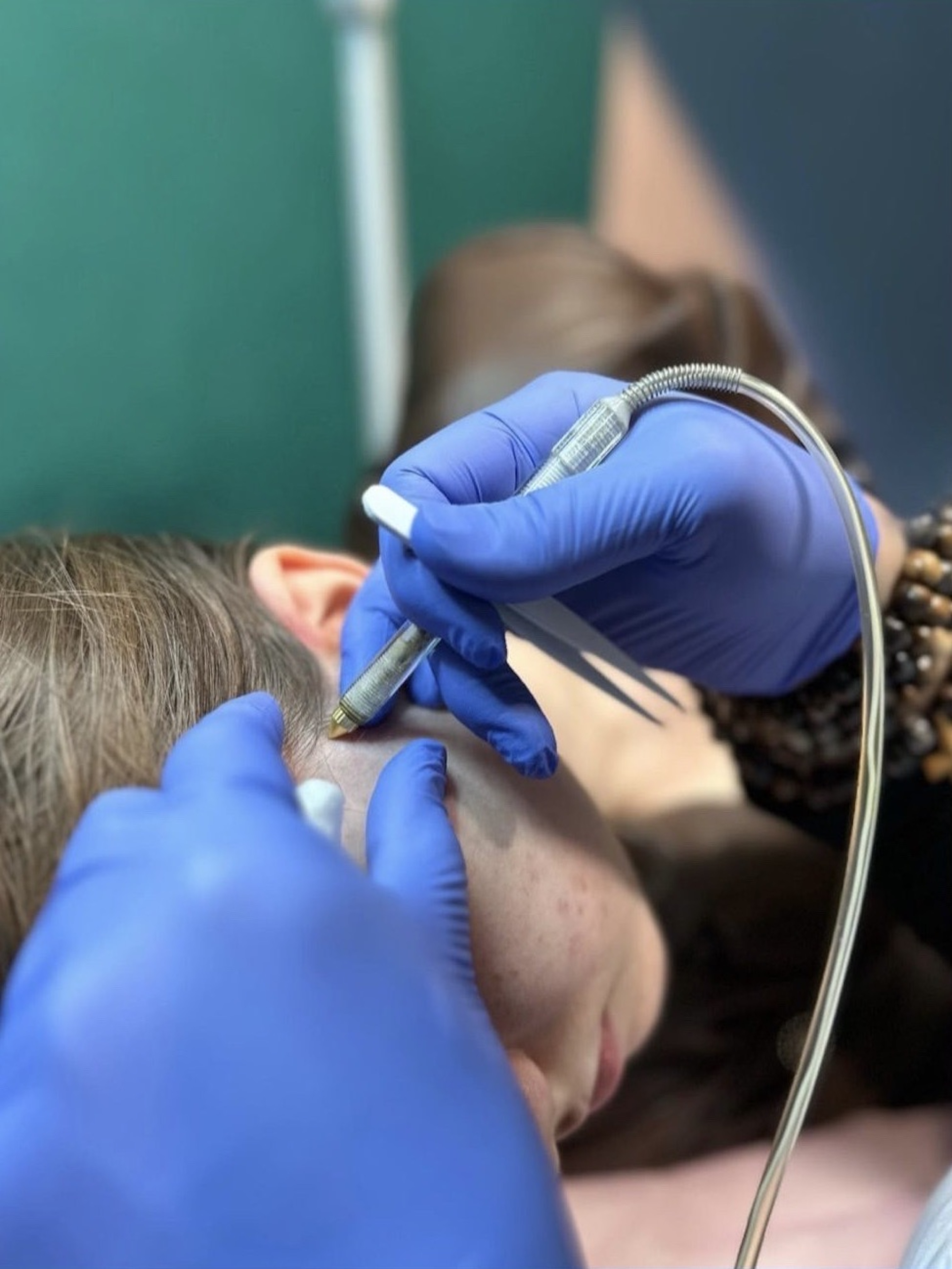 ნემსით ეპილაცია